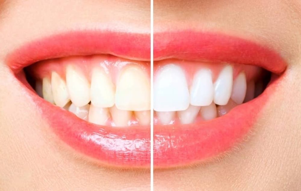 Before and after teeth whitening.