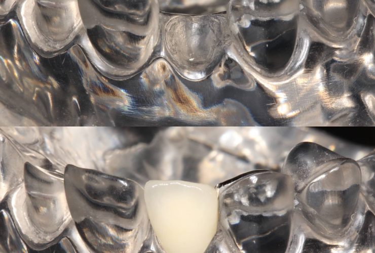 dental bridge before and after