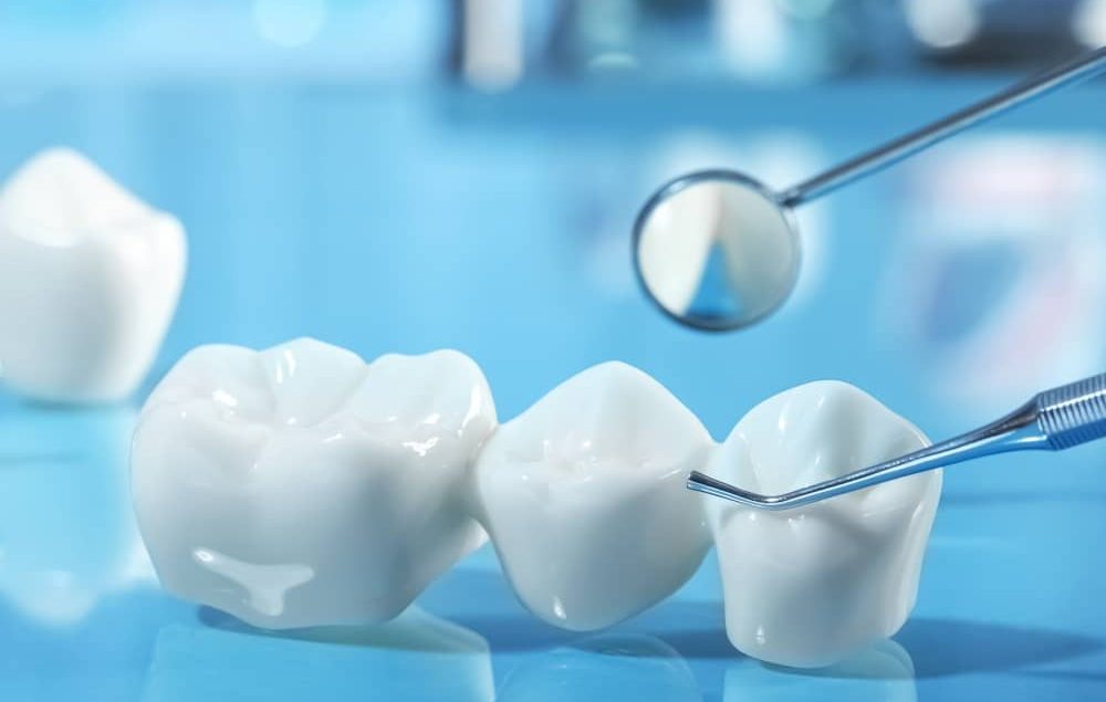 When considering all your tooth replacement options, dental bridges are an excellent aesthetic solution for missing teeth.