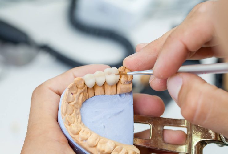 What Are the Benefits of a Dental Bridge?