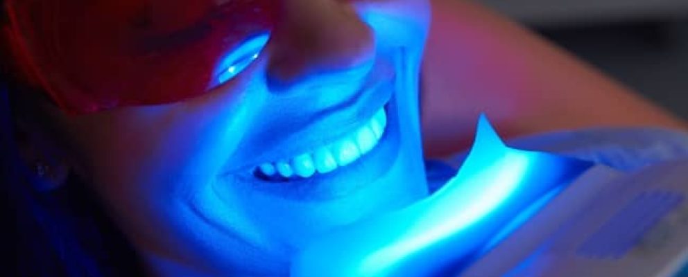 lady using fluoride teeth whitening machine